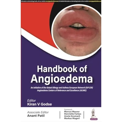 Afbeelding van Handbook of Angioedema