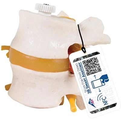 Afbeelding van 3B Scientific A76/9 2 lendenwervels met tussenwervelschijf prolaps, elastische montage + gratis anatomie software Smart Anatomy