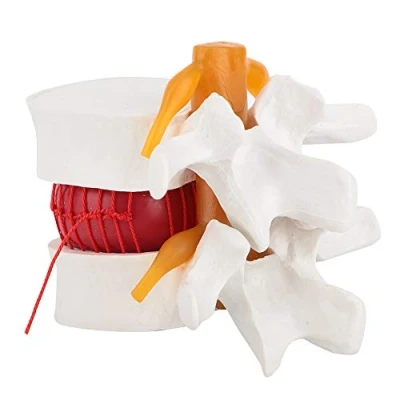 Afbeelding van menselijke anatomie, lumbale hernia demonstratie model 1:1,5 wervelkolom voor medische
