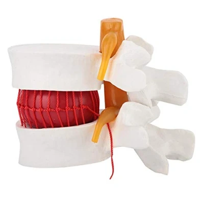 Afbeelding van 1: 1,5 Menselijke Lumbale Schijf Hernia Model Wervelkolom Anatomische Studie Demonstratie Display Educatief Tool