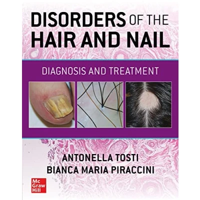 Afbeelding van Disorders of the Hair and Nail: Diagnosis Treatment